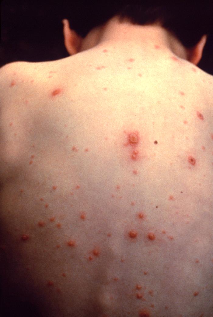 As state considers vaccine changes, new online tool examines sickness, death, cost impacts